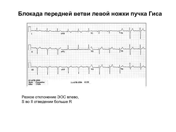 Блокада передней ветви левой ножки пучка Гиса Резкое отклонение ЭОС влево, S