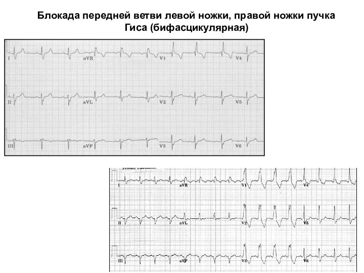 Блокада передней ветви левой ножки, правой ножки пучка Гиса (бифасцикулярная)