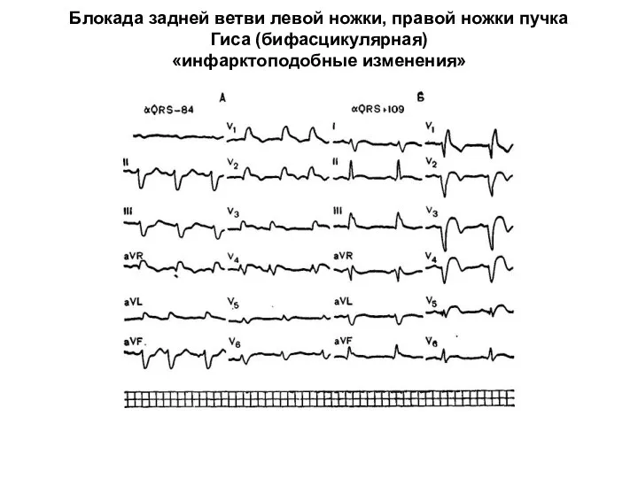 Блокада задней ветви левой ножки, правой ножки пучка Гиса (бифасцикулярная) «инфарктоподобные изменения»