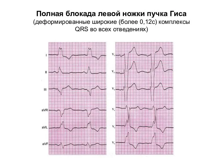 Полная блокада левой ножки пучка Гиса (деформированные широкие (более 0,12с) комплексы QRS во всех отведениях)