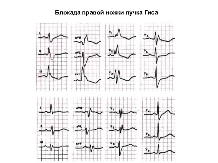 Блокада правой ножки пучка Гиса