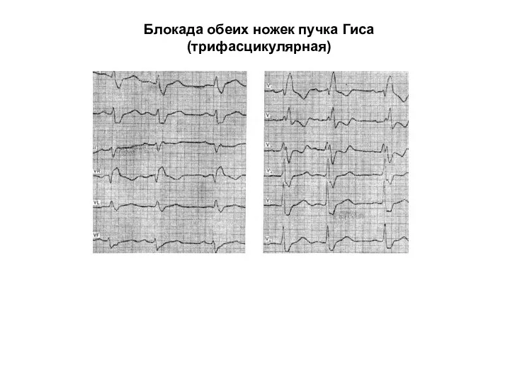 Блокада обеих ножек пучка Гиса (трифасцикулярная)