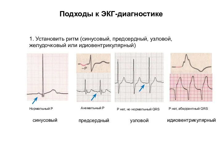 Подходы к ЭКГ-диагностике 1. Установить ритм (синусовый, предсердный, узловой, желудочковый или идиовентрикулярный)