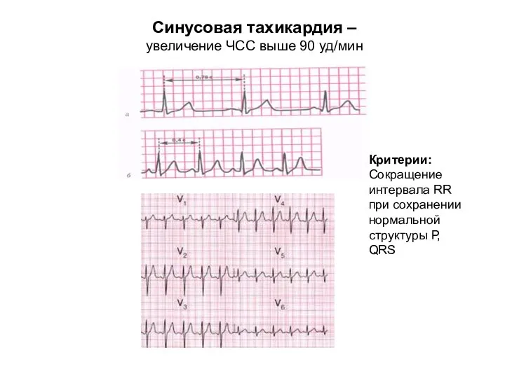 Синусовая тахикардия – увеличение ЧСС выше 90 уд/мин Критерии: Сокращение интервала RR