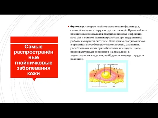 Самые распространённые гнойничковые заболевания кожи Фурункул– острое гнойное воспаление фолликула, сальной железы