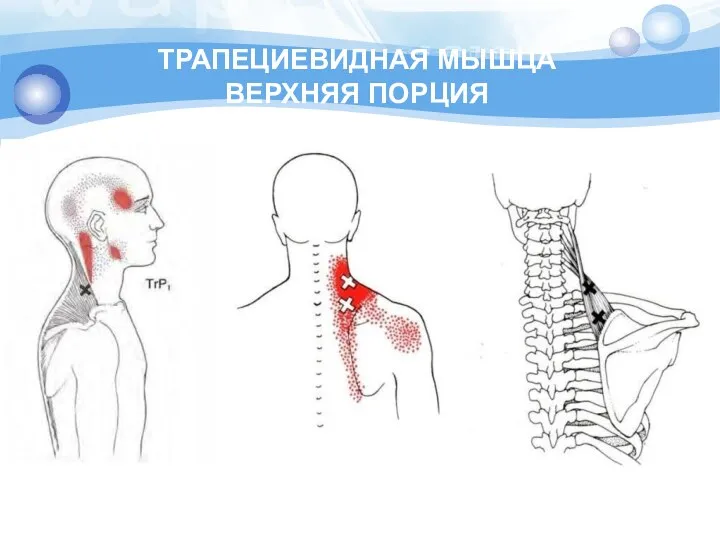 ТРАПЕЦИЕВИДНАЯ МЫШЦА ВЕРХНЯЯ ПОРЦИЯ