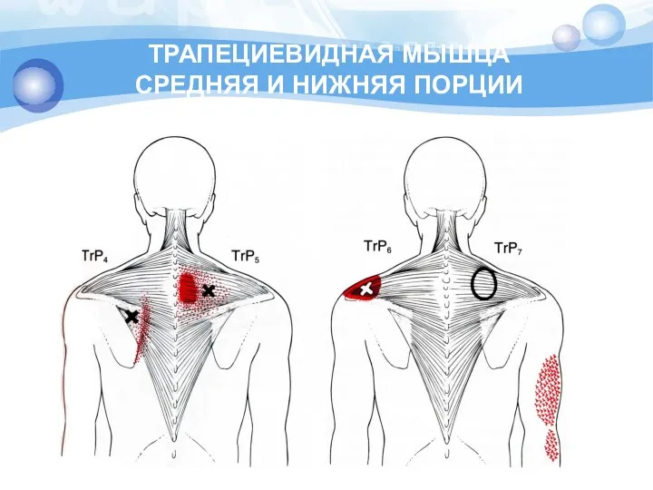 ТРАПЕЦИЕВИДНАЯ МЫШЦА СРЕДНЯЯ И НИЖНЯЯ ПОРЦИИ