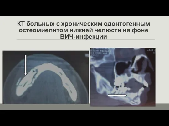 КТ больных с хроническим одонтогенным остеомиелитом нижней челюсти на фоне ВИЧ-инфекции