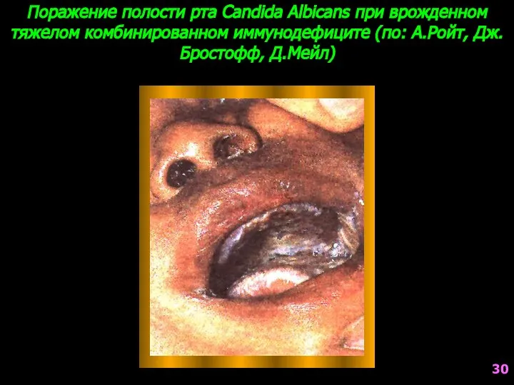 Поражение полости рта Candida Albicans при врожденном тяжелом комбинированном иммунодефиците (по: А.Ройт, Дж.Бростофф, Д.Мейл) 30