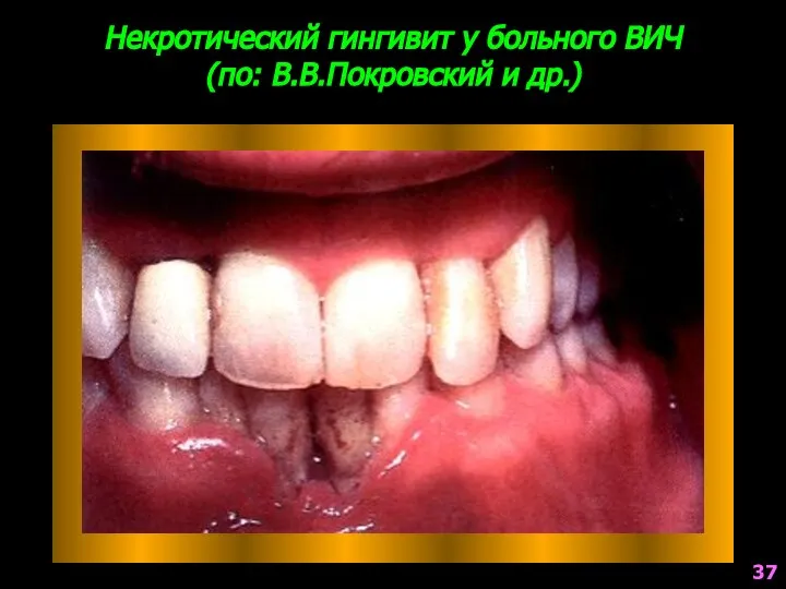 Некротический гингивит у больного ВИЧ (по: В.В.Покровский и др.) 37