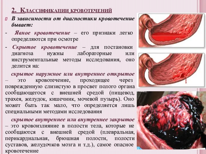 2. Классификации кровотечений В зависимости от диагностики кровотечение бывает: - Явное кровотечение