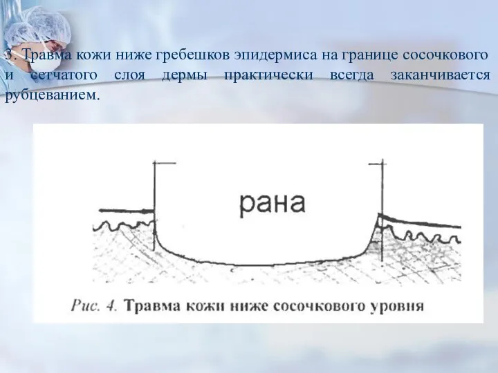 3. Травма кожи ниже гребешков эпидермиса на границе сосочкового и сетчатого слоя