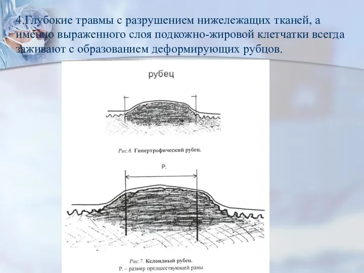 4.Глубокие травмы с разрушением нижележащих тканей, а именно выраженного слоя подкожно-жировой клетчатки