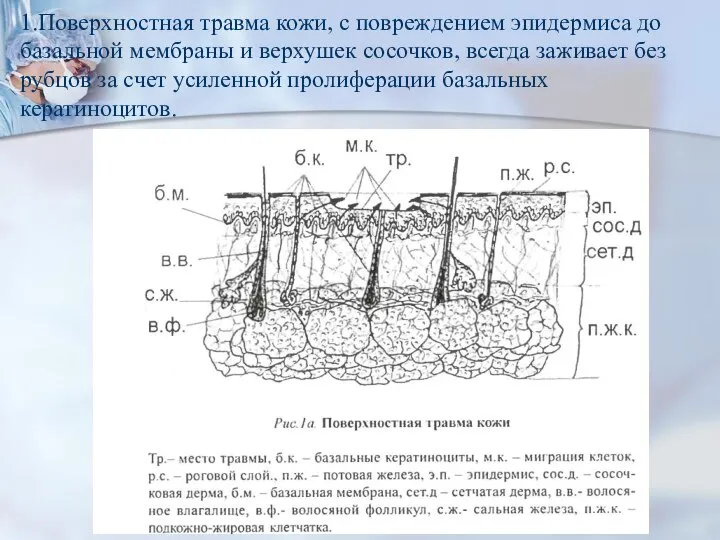 1.Поверхностная травма кожи, с повреждением эпидермиса до базальной мембраны и верхушек сосочков,