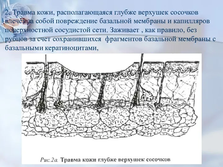 2. Травма кожи, располагающаяся глубже верхушек сосочков влечет за собой повреждение базальной