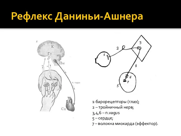 Рефлекс Даниньи-Ашнера 1-барорецепторы (глаз); 2 – тройничный нерв; 3,4,6 – n.vagus 5