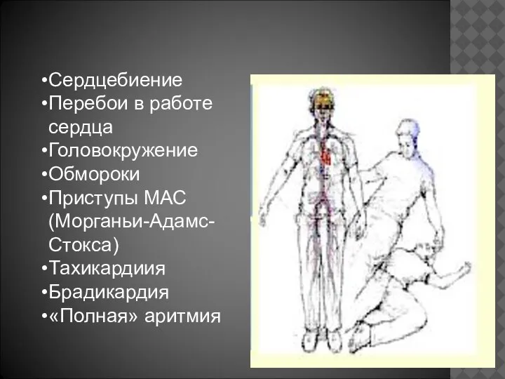 Сердцебиение Перебои в работе сердца Головокружение Обмороки Приступы МАС (Морганьи-Адамс-Стокса) Тахикардиия Брадикардия «Полная» аритмия