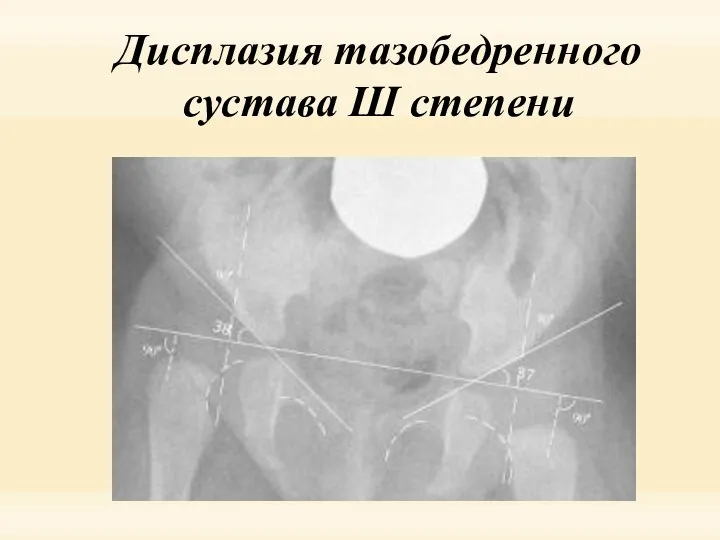 Дисплазия тазобедренного сустава Ш степени