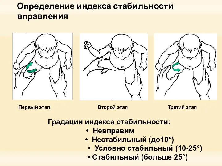 Определение индекса стабильности вправления Первый этап Третий этап Градации индекса стабильности: •