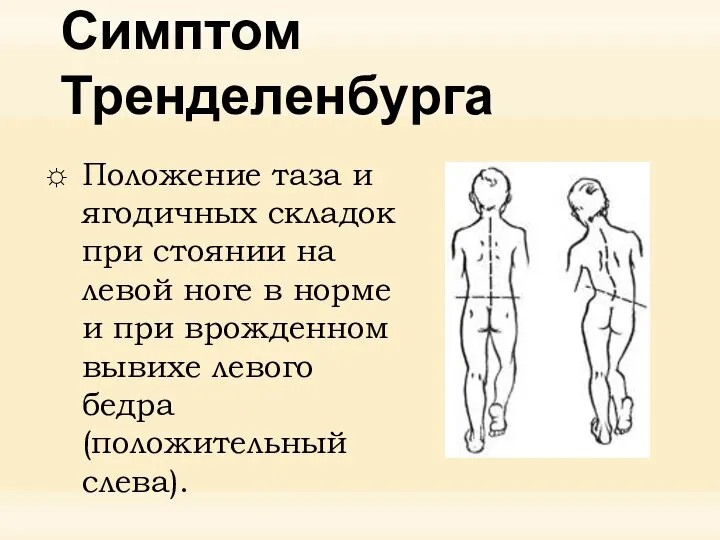 Симптом Тренделенбурга Положение таза и ягодичных складок при стоянии на левой ноге