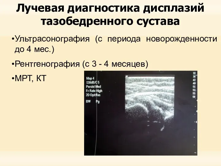 Лучевая диагностика дисплазий тазобедренного сустава Ультрасонография (с периода новорожденности до 4 мес.)