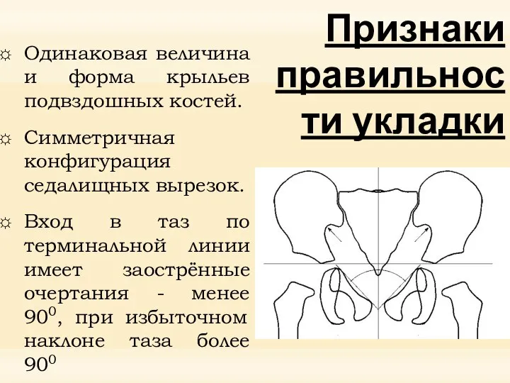 Признаки правильности укладки Одинаковая величина и форма крыльев подвздошных костей. Симметричная конфигурация