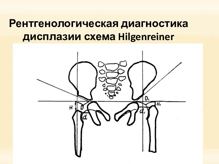 Рентгенологическая диагностика дисплазии схема Hilgenreiner