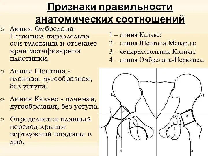 Признаки правильности анатомических соотношений Линия Омбредана-Перкинса параллельна оси туловища и отсекает край