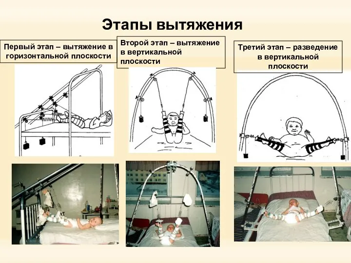 Этапы вытяжения Первый этап – вытяжение в горизонтальной плоскости Второй этап –