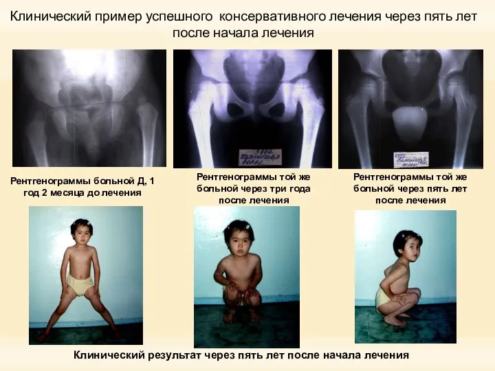 Клинический пример успешного консервативного лечения через пять лет после начала лечения Рентгенограммы
