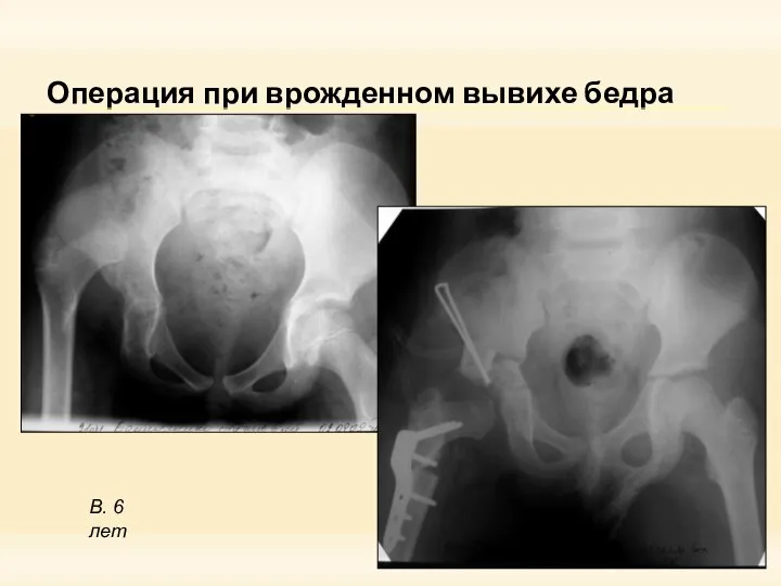 Операция при врожденном вывихе бедра В. 6 лет