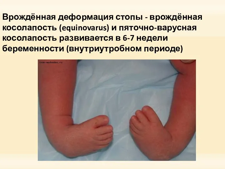 Врождённая деформация стопы - врождённая косолапость (equinovarus) и пяточно-варусная косолапость развивается в