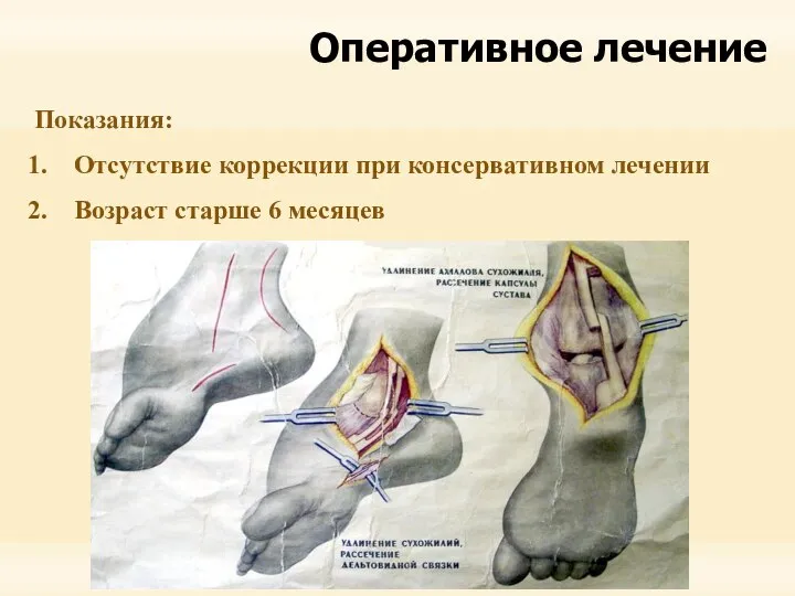 Оперативное лечение Показания: Отсутствие коррекции при консервативном лечении Возраст старше 6 месяцев