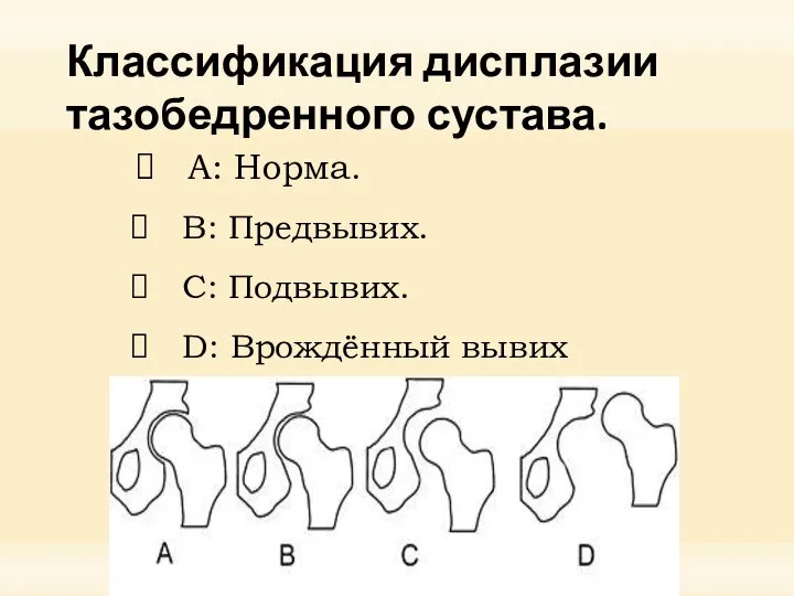 Классификация дисплазии тазобедренного сустава. A: Норма. B: Предвывих. C: Подвывих. D: Врождённый вывих