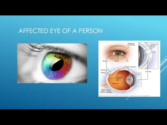 AFFECTED EYE OF A PERSON