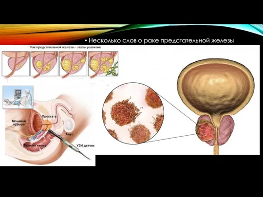 Несколько слов о раке предстательной железы