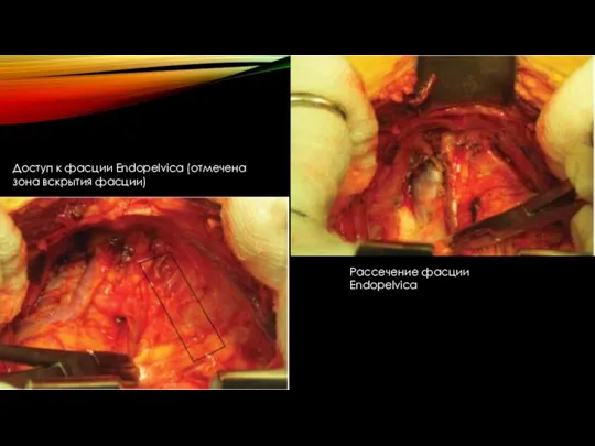 Доступ к фасции Endopelvica (отмечена зона вскрытия фасции) Рассечение фасции Endopelvica