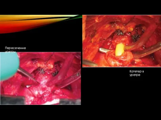Катетер в уретре Пересечение уретры
