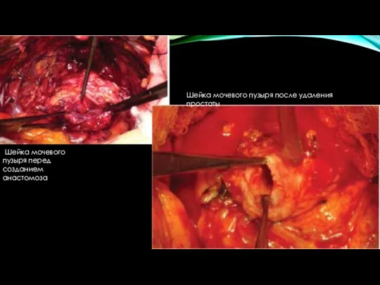 Шейка мочевого пузыря перед созданием анастомоза Шейка мочевого пузыря после удаления простаты