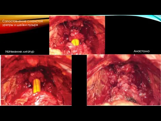 Анастомоз Сопоставление слизистой уретры и шейки пузыря Натяжение лигатур