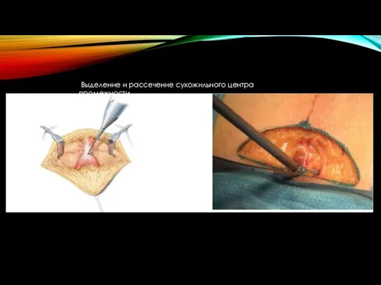 Выделение и рассечение сухожильного центра промежности.