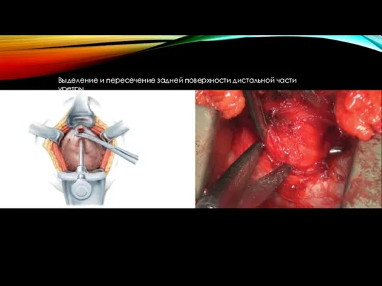 Выделение и пересечение задней поверхности дистальной части уретры.