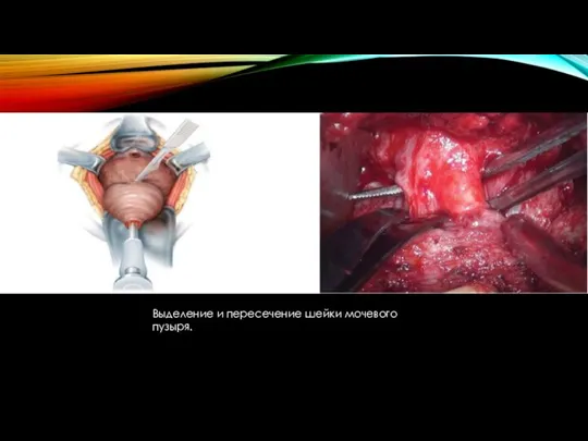 Выделение и пересечение шейки мочевого пузыря.