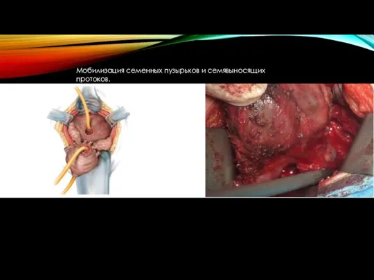 Мобилизация семенных пузырьков и семявыносящих протоков.