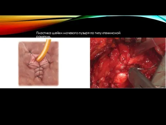 Пластика шейки мочевого пузыря по типу «теннисной ракетки».