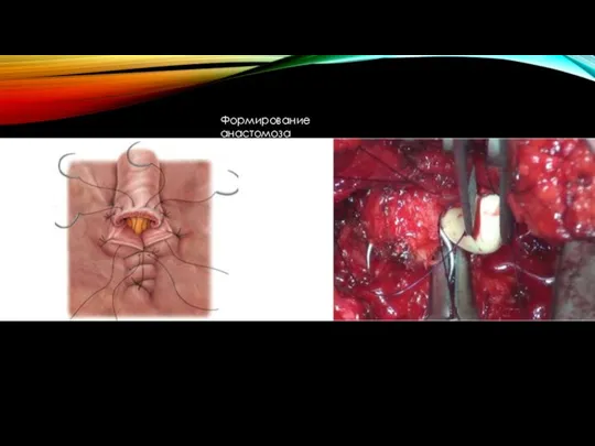 Формирование анастомоза
