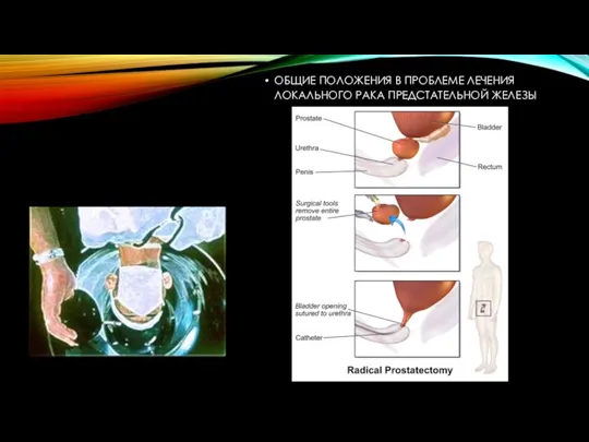 ОБЩИЕ ПОЛОЖЕНИЯ В ПРОБЛЕМЕ ЛЕЧЕНИЯ ЛОКАЛЬНОГО РАКА ПРЕДСТАТЕЛЬНОЙ ЖЕЛЕЗЫ