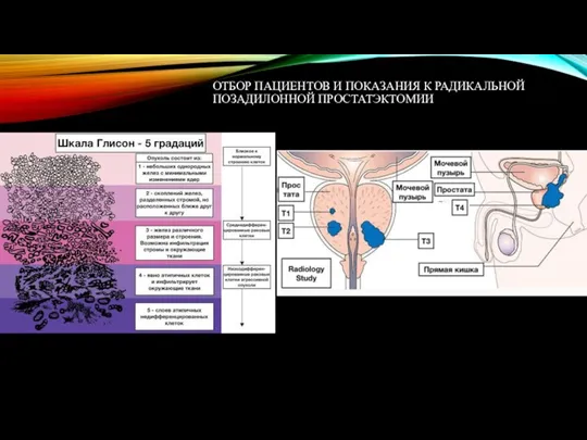 ОТБОР ПАЦИЕНТОВ И ПОКАЗАНИЯ К РАДИКАЛЬНОЙ ПОЗАДИЛОННОЙ ПРОСТАТЭКТОМИИ