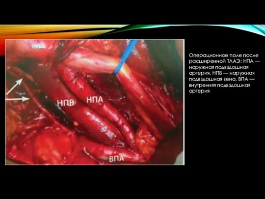 Операционное поле после расширенной ТЛАЭ: НПА — наружная подвздошная артерия, НПВ —