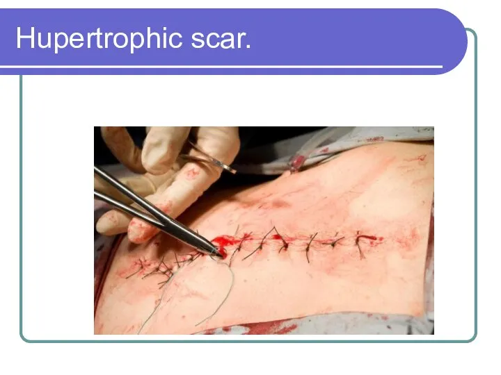 Hupertrophic scar.